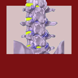 TENS for Facet Syndrome