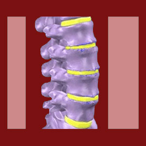 Degenerative disc disease and facet joint syndrome