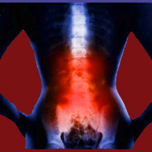 Excruciating Facet Joint Pain