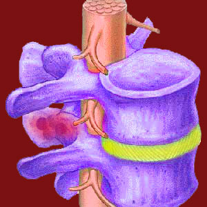 Facet joint bone spurs