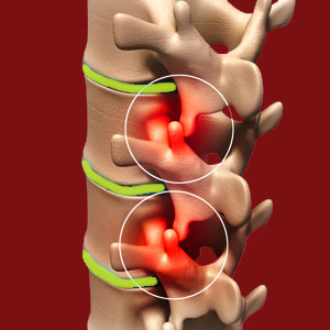 Facet joint degeneration