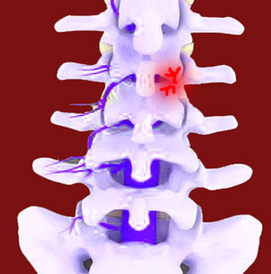 Facet Joint Injections