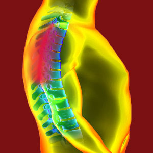 Facet joint ischemia