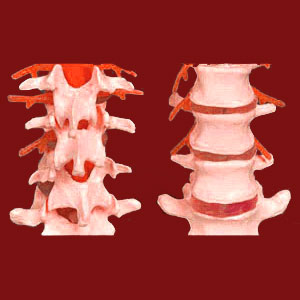 Facet joint osteophytes