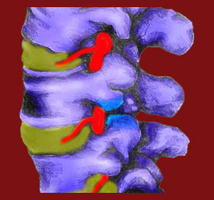 facet joint syndrome