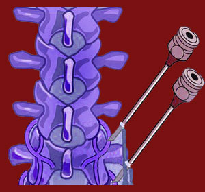 facet syndrome diagnosis